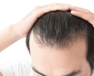 Minoxidil and Hair Growth: Is It Safe and Effective?