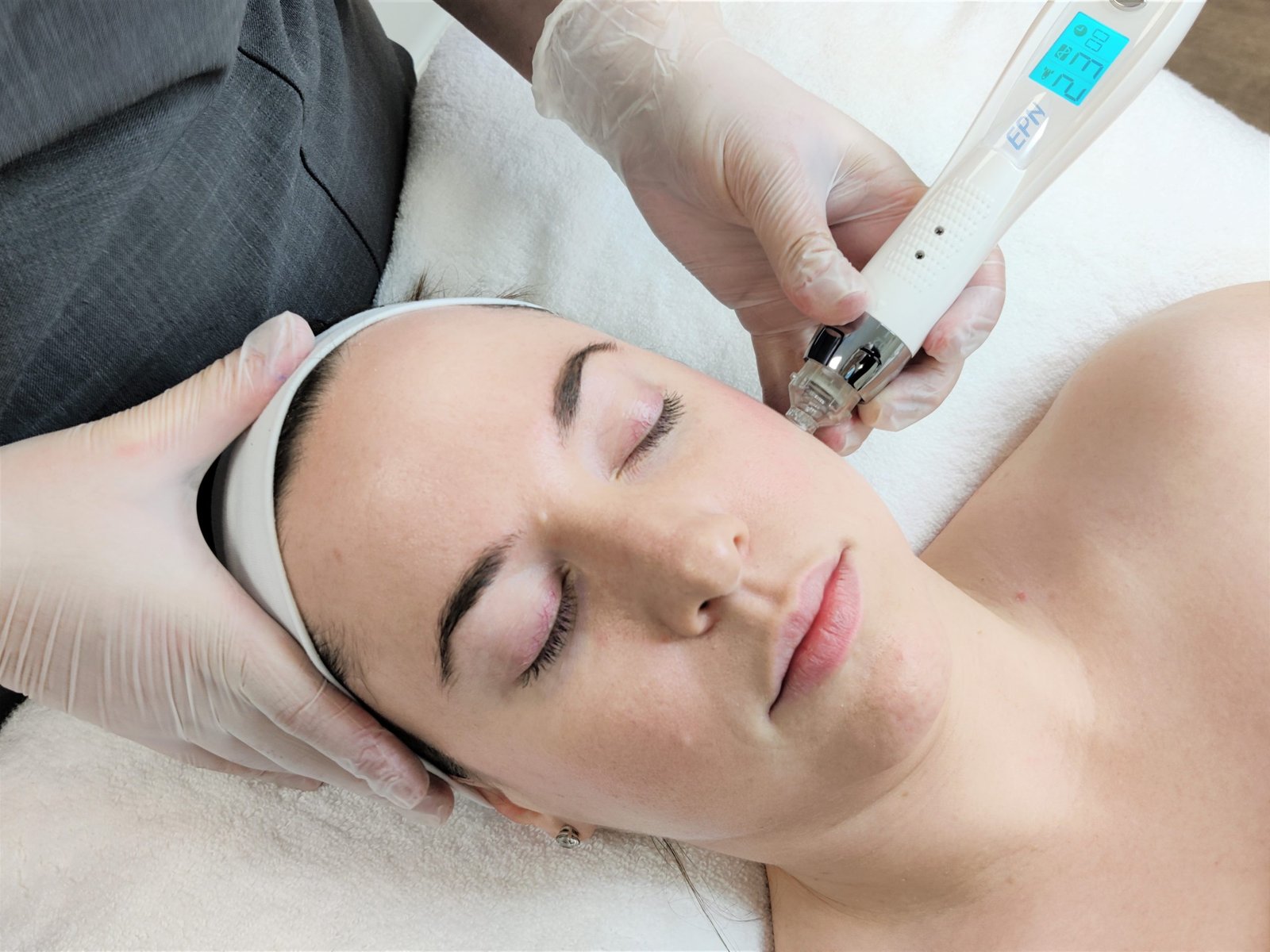 Skin Pen Micro Needling in Frisco