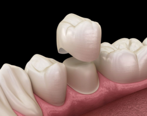 Ceramic Crown in Abu Dhabi: Durable and Aesthetic Option
