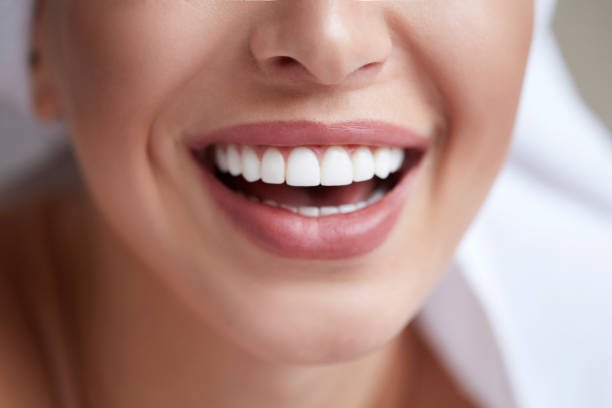 Teeth Whitening in Riyadh