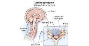 Cervical Spondylosis Treatment Procedures What You Need to Know
