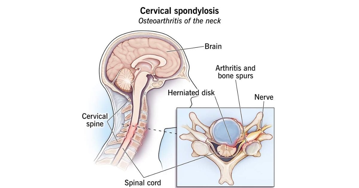 Cervical Spondylosis Treatment Procedures What You Need to Know