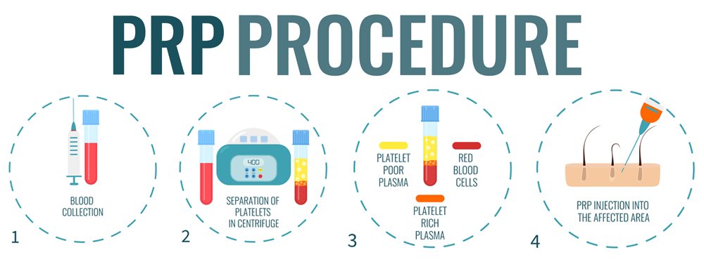 PRP treatment