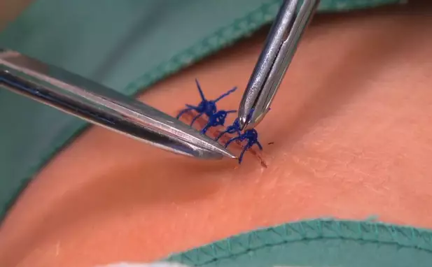 Suture Removal at Home in Dubai