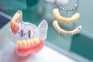 Dental Implants