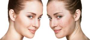 Best Acne Treatment in Dubai
