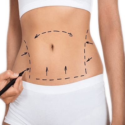 Best Mini Tummy Tuck in Dubai