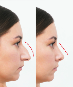 Best Rhinoplasty Surgeon For Nose Surgery Dubai
