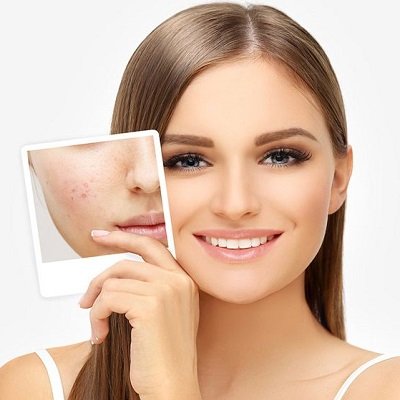 Clear Skin Ahead Innovative Acne Treatments That Actually Work