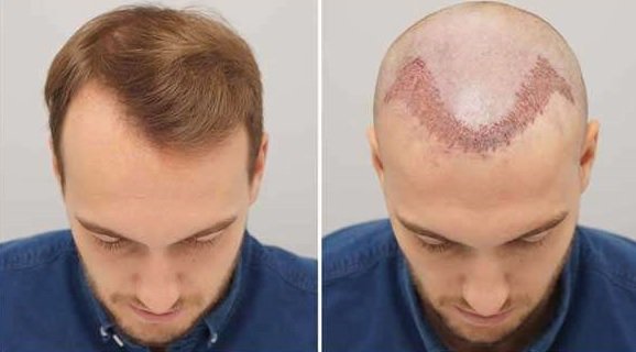 Hair Transplant in Dubai: Best Surgeon, Top Rated Clinic