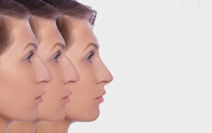 Nose Tip Plasty Can Improve Your Overall Appearance