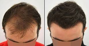 Non-Surgical Hair Transplant in Lahore