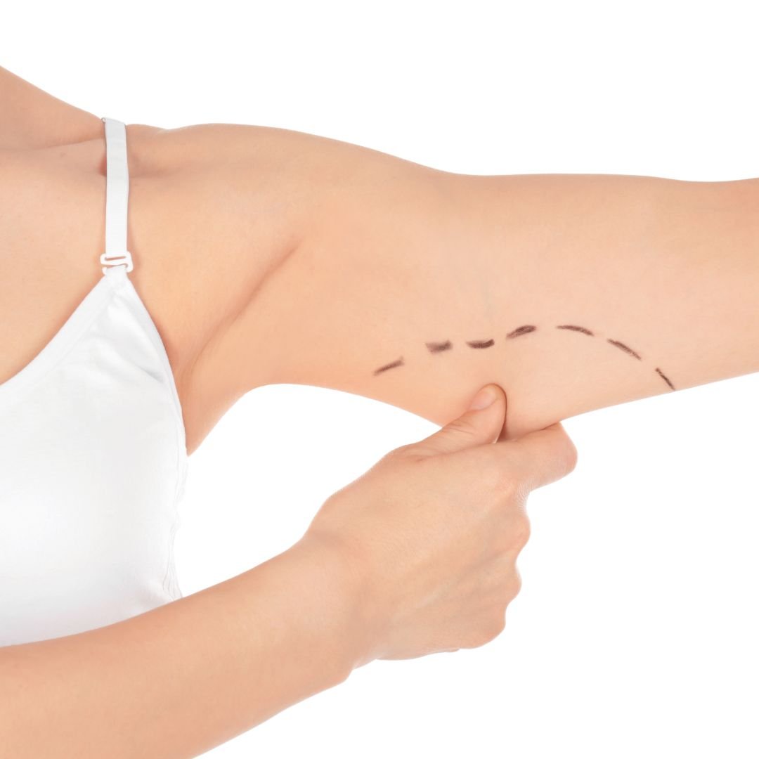 Arm Lift Surgery: Benefits, Recovery and Is It Worth It