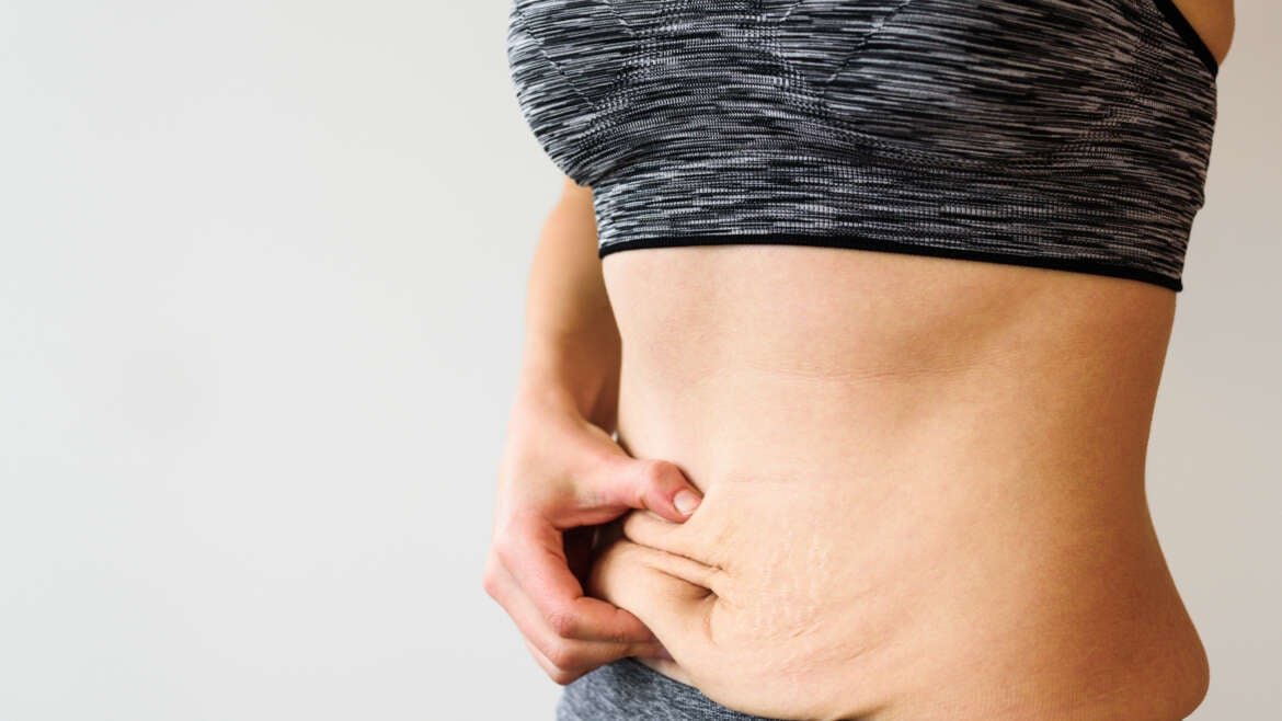 Bodytite Liposuction: How It Enhances Your Natural Shape