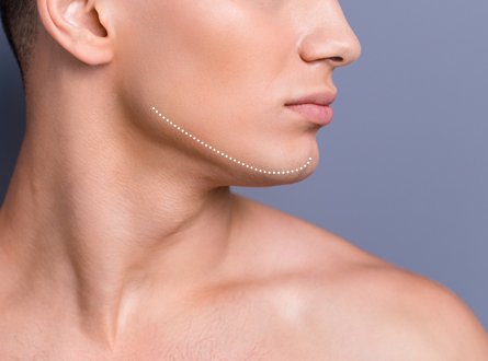 Chin Reduction: What Happens During the Procedure