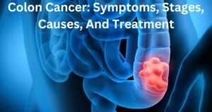 Colon-Cancer