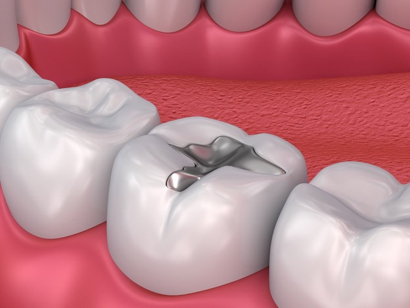 Cost of Dental Filling: Why It Varies by Tooth Location