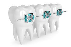 Cost of Orthodontics: Balancing Quality and Affordability