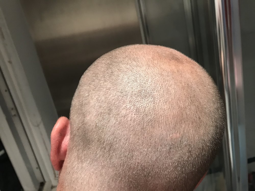 Hair Transplant Results Timeline: Month-by-Month Progress