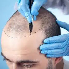 Hair Transplant in Dubai