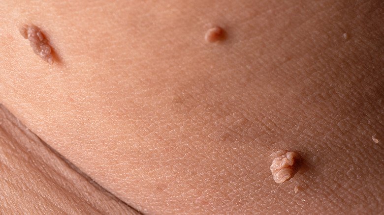 How to Remove Skin Tags on Inner Thigh: What Really Works