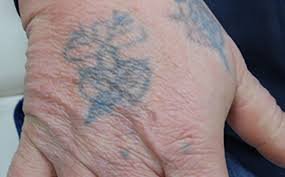 Laser Tattoo Removal: A Safe Path to Clean, Tattoo-Free Skin