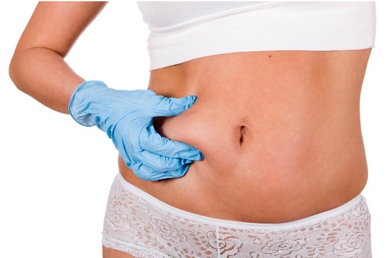 Lipo Abdominoplasty: Solution for a Contoured Midsection