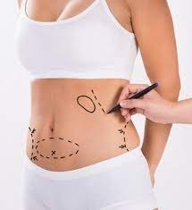 Mini Abdominoplasty: Achieving Ideal Body with Minimal Fuss