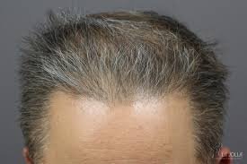 P R P Treatment for White Hair: Who Should Avoid It