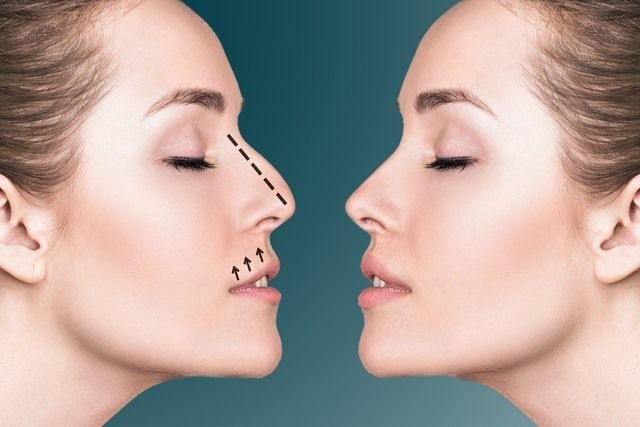 Rhinoplasty in Riyadh