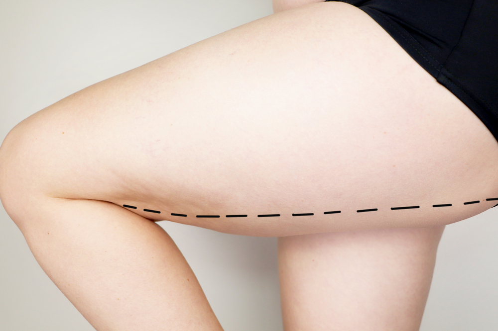 Thigh Lift Can Help You Feel Confident Again