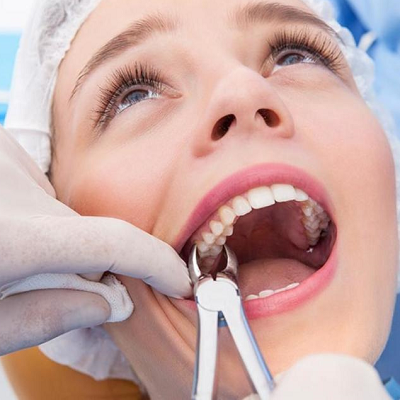 Tooth Extraction What to Expect and How to Heal Like a Pro