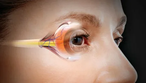 What is Glaucoma, and symptoms