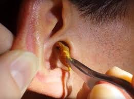 ear wax removal north york