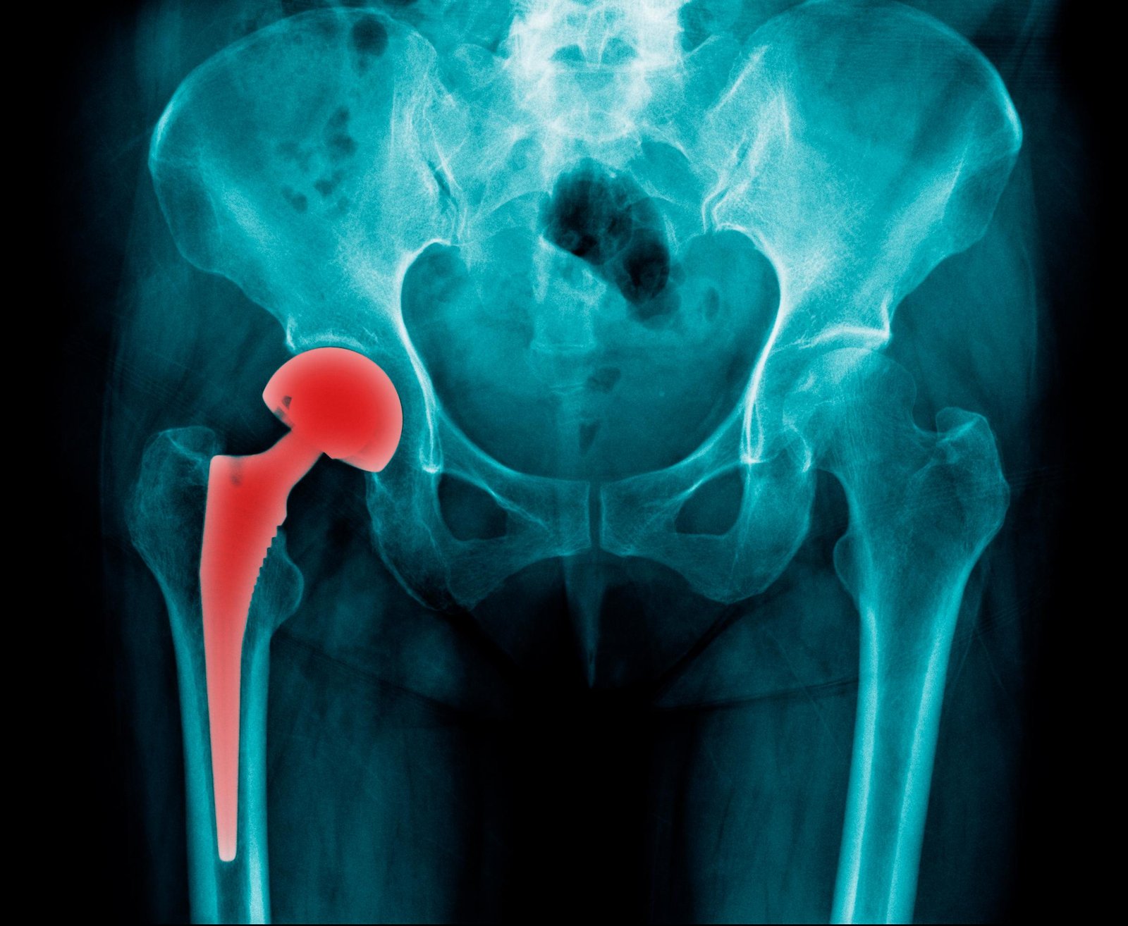 hip replacement cost in Pakistan