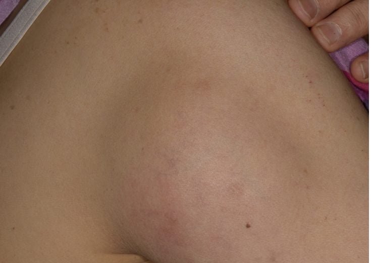 Lipoma Treatment: Successful Solutions of Lipoma