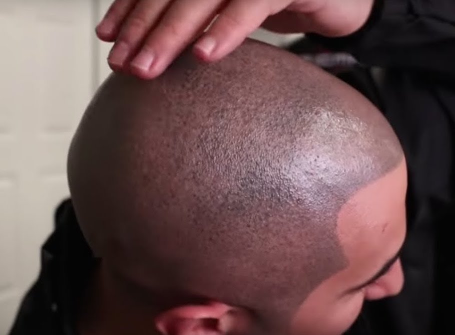 Scalp Micropigmentation: Best Ways to Maintain Your Look