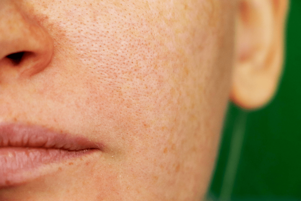 What Are the Most Effective Solutions for Dermal Pigmentation