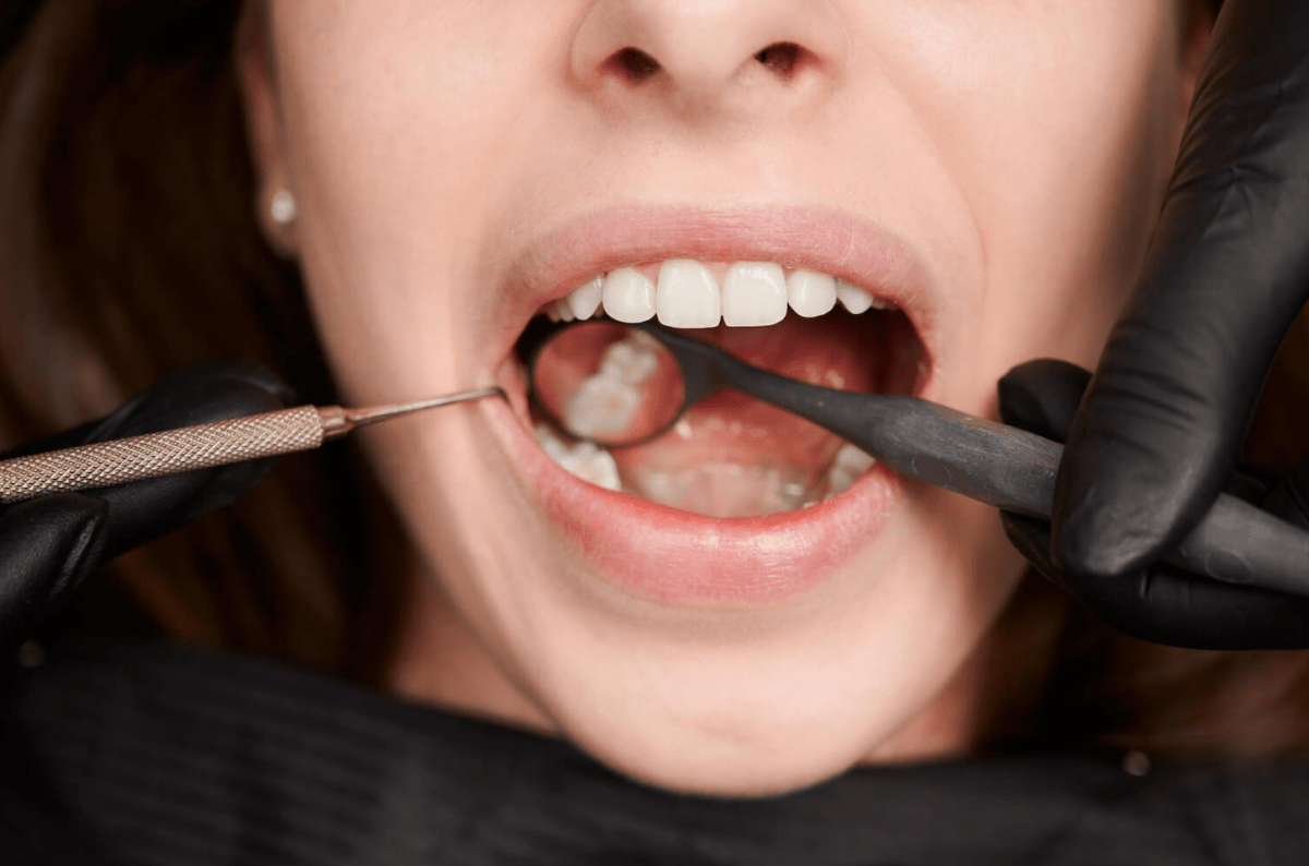 Wisdom Tooth Extraction: What to Expect Before Surgery