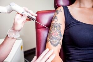 Laser Tattoo Removal