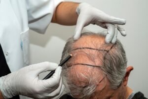 Bio-Enhanced FUE Hair Transplant, A Revolutionary Method