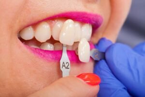 Cost of Dental Veneers: What’s the Real Price in Your City