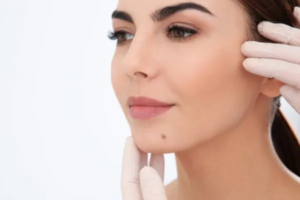 Everything You Should Know About Mole Removal