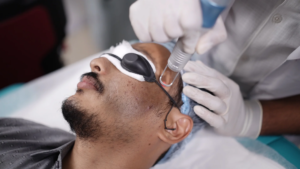 How Does Laser Carbon Peel Work for Men’s Skin?