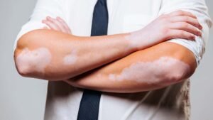 Is Vitiligo Treatment Effective for Both Small and Large Areas?