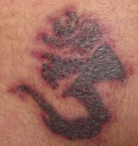 Laser Tattoo Removal: Injury Warning Signs