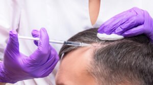 PRP Hair Therapy The Natural Way to Restore Your Hairline