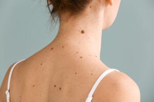 What Can You Expect After Seborrheic Keratosis Treatment?