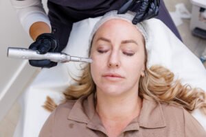 What Happens During RF Micro Needling Sessions?