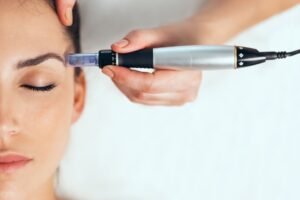 What to Know Before RF Micro Needling Treatment?